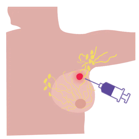 Biopsia del linfonodo centinela