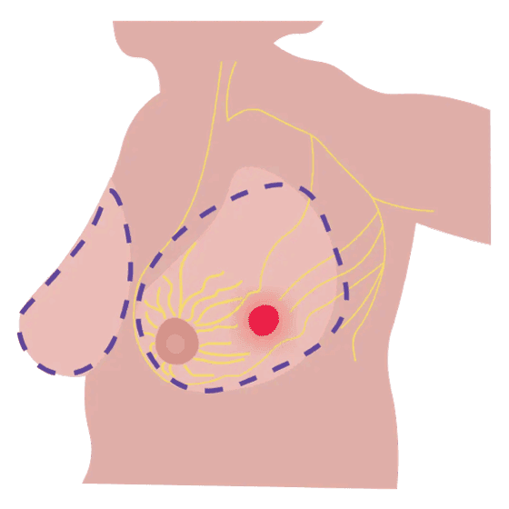 Ilustración mastectomía modificada