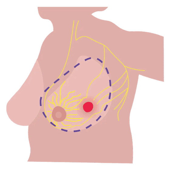 Ilustración mastectomía radical