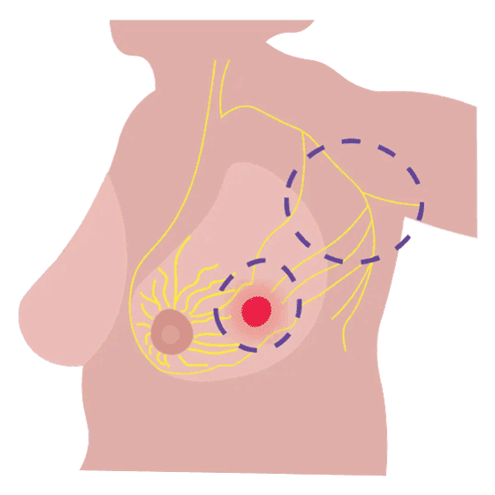 Ilustración mastectomía radical