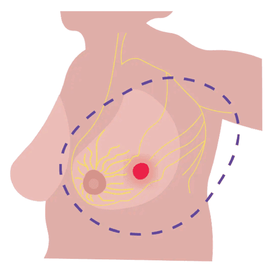 Ilustración mastectomía radical